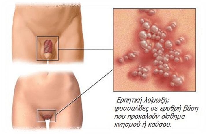 Τα κονδυλώματα σαρώνουν την νεολαία σαν κοινό κρυολόγημα