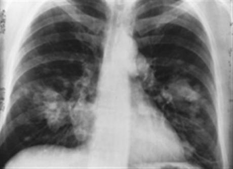 Λιγότερο από το 20% των σκιών στον πνεύμονα είναι καρκίνος