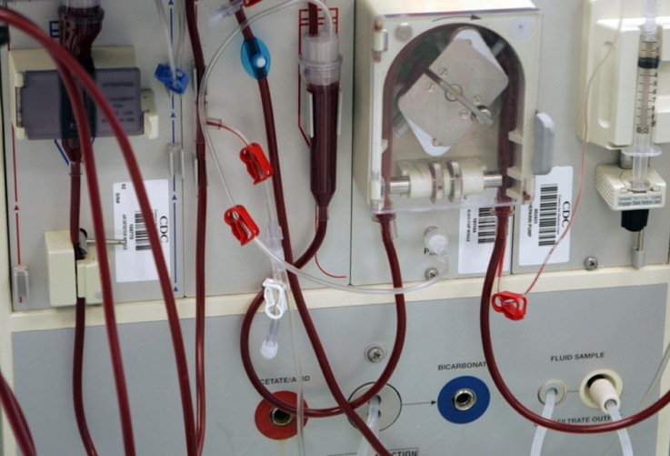 Καταγγελίες για τις προμήθειες φίλτρων τεχνητού νεφρού