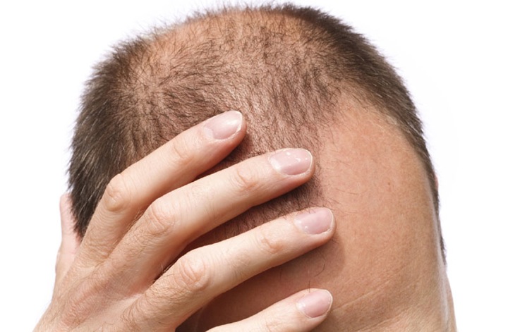 Γιατί οι άνδρες χάνουν τα μαλλιά τους & ποια είναι η λύση;