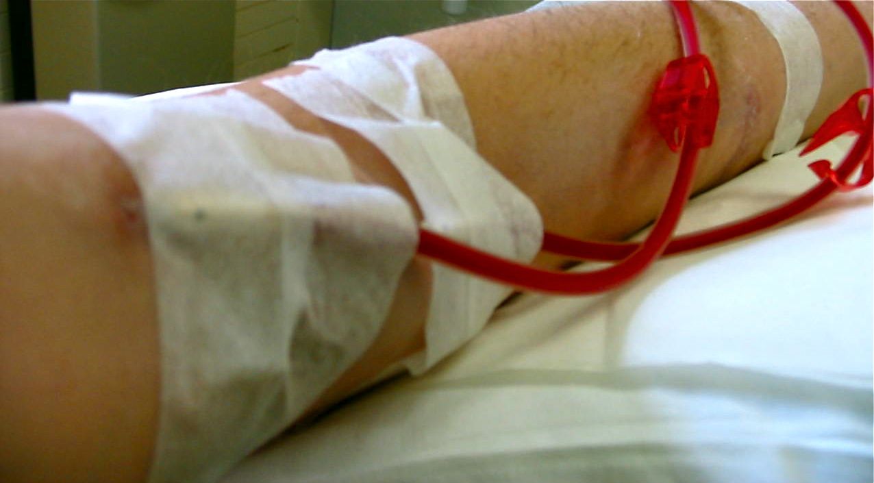 ΣΔΟΕ: Τι έδειξε έρευνα για καρτέλ φίλτρων αιμοκάθαρσης