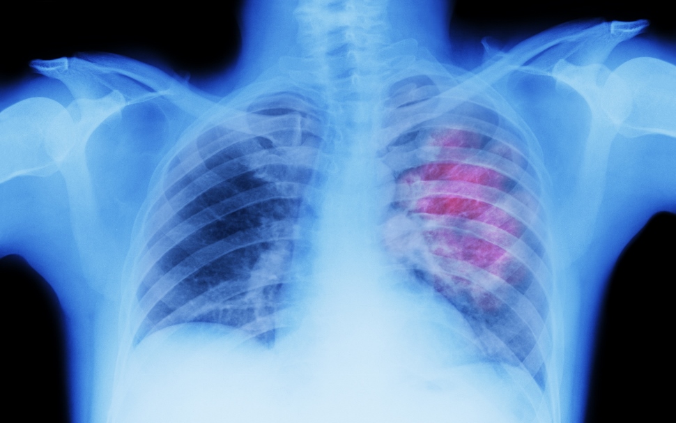 Καρκίνος πνεύμονα: Έως και 20 χρόνια σε λανθάνουσα μορφή