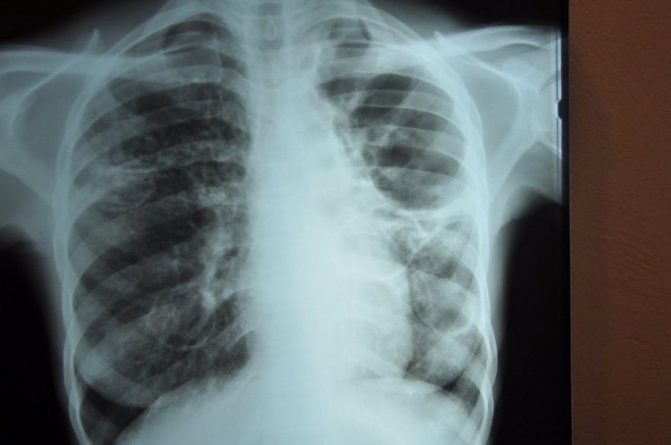 ΠΟΥ: Η εξάπλωση της πολυανθεκτικής φυματίωσης