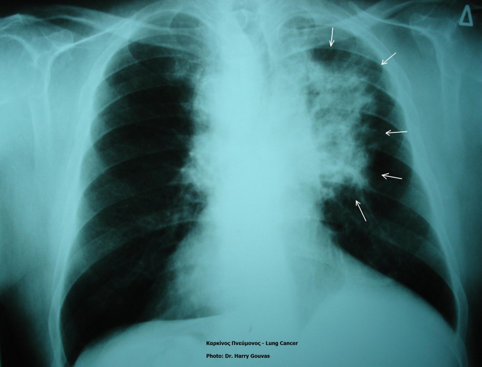 Προληπτική εξέταση χτυπά τον καρκίνο του πνεύμονα