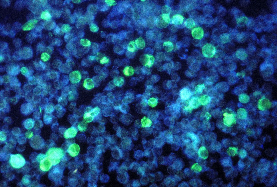 Ερευνητές μεταλλάσσουν τα λευχαιμικά κύτταρα σε αβλαβή
