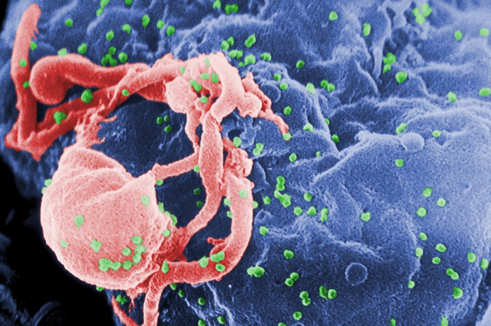 HIV: Μπορεί να εξαπλωθεί & να αναπράγεται στον εγκέφαλο;