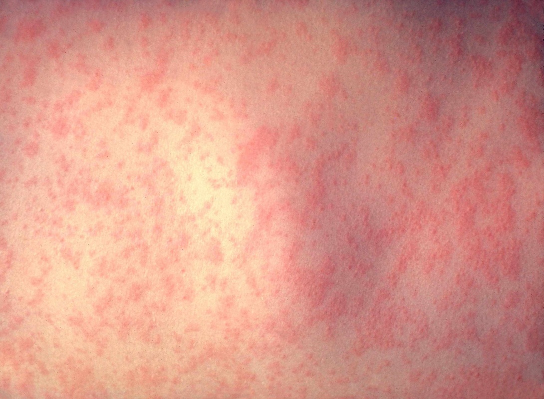 Τρία χρόνια παραμένουν οι επιπτώσεις της ιλαράς