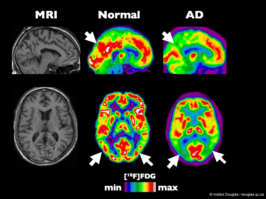 Αλτσχάιμερ:Πλάκες του εγκεφάλου προβλέπουν τη νόσο