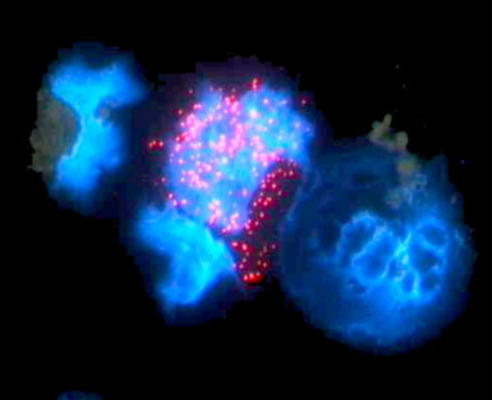 Ο ρόλος των tRNA μορίων στην ανάπτυξη του καρκίνου
