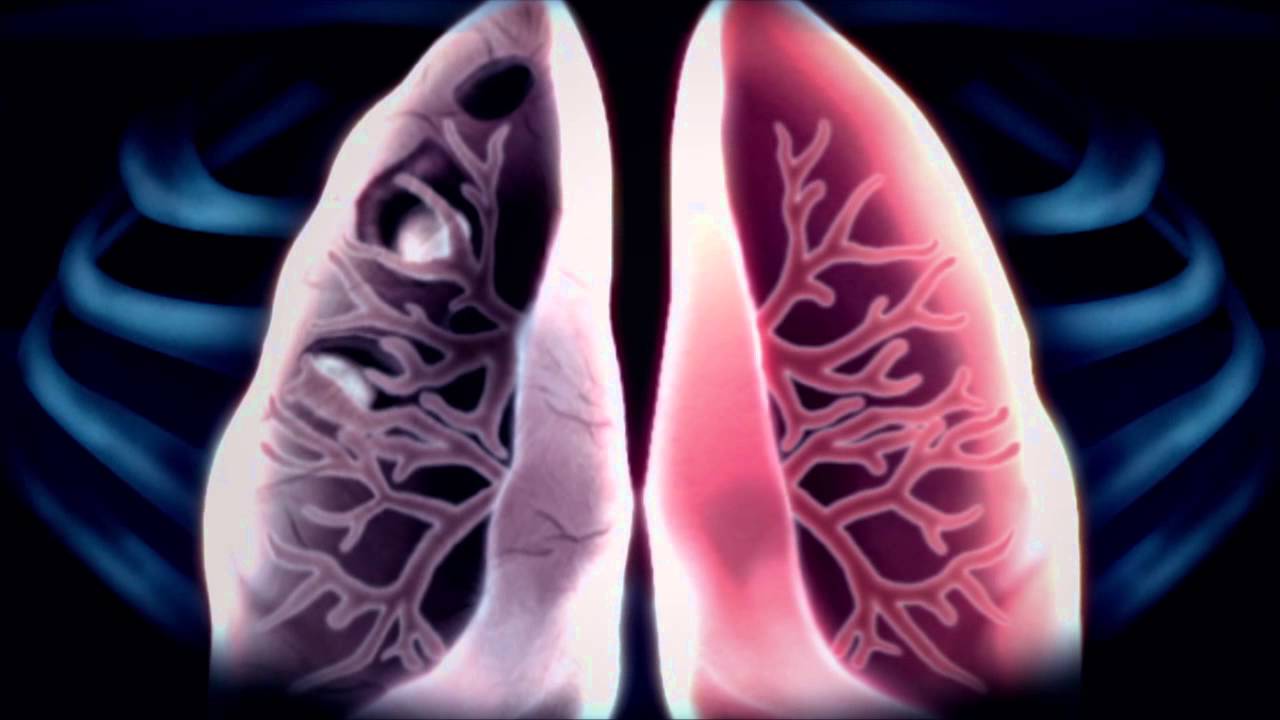 Φυματίωση: Κύρια αιτία θανάτου υποστηρίζει ο ΠΟΥ