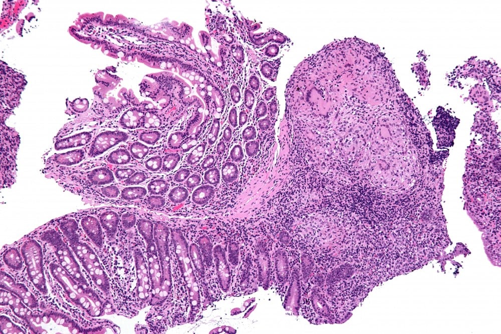 Νόσος του Crohn: Ποια είναι η κατάλληλη διατροφή;