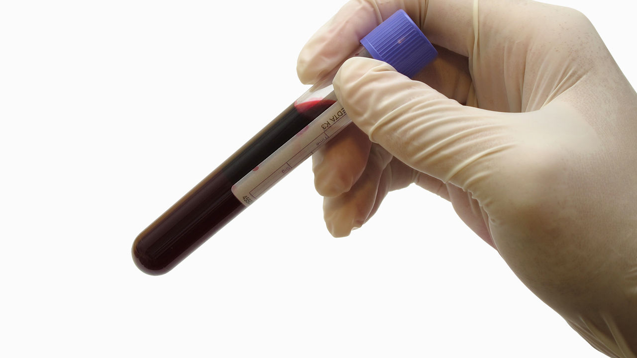Εξέταση αίματος «αποκαλύπτει» τον καρκίνο των ωοθηκών