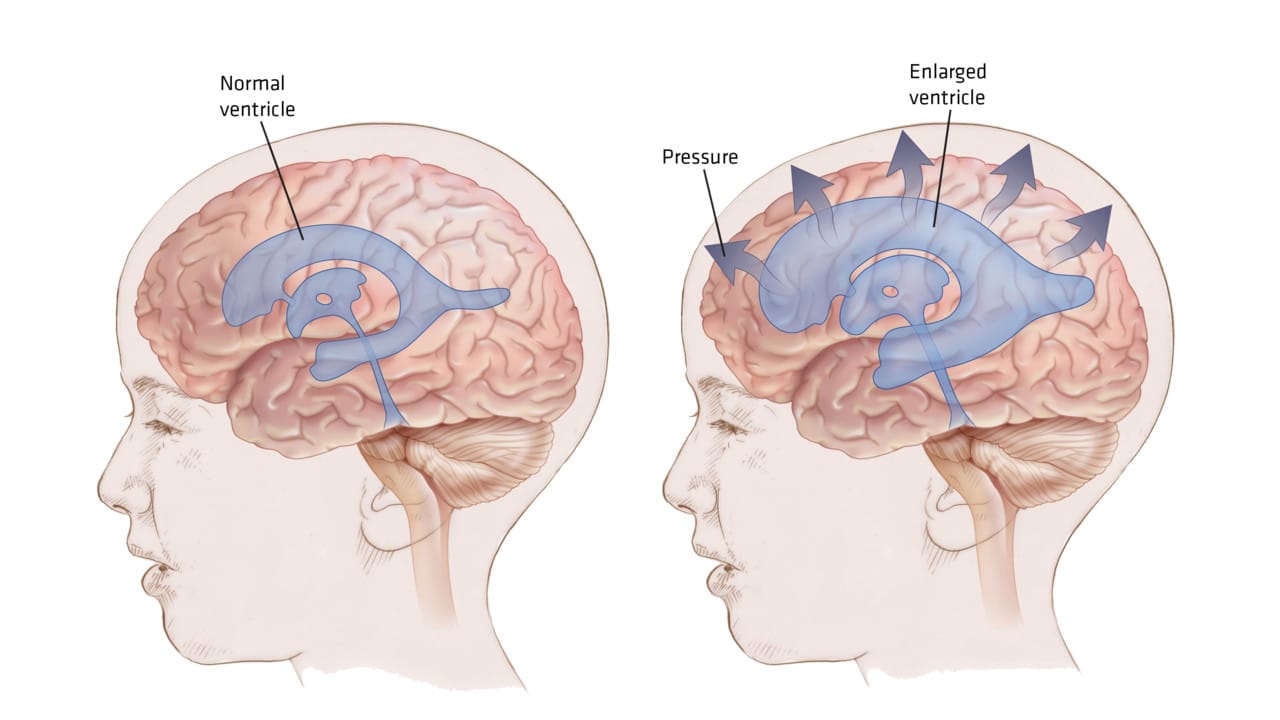 Υδροκέφαλος: Τι είναι και πώς απειλεί τη ζωή