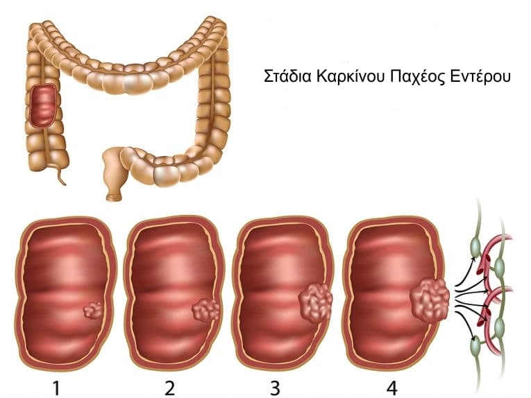 Ο καρκίνος του εντέρου «θερίζει» στις αναπτυγμένες χώρες