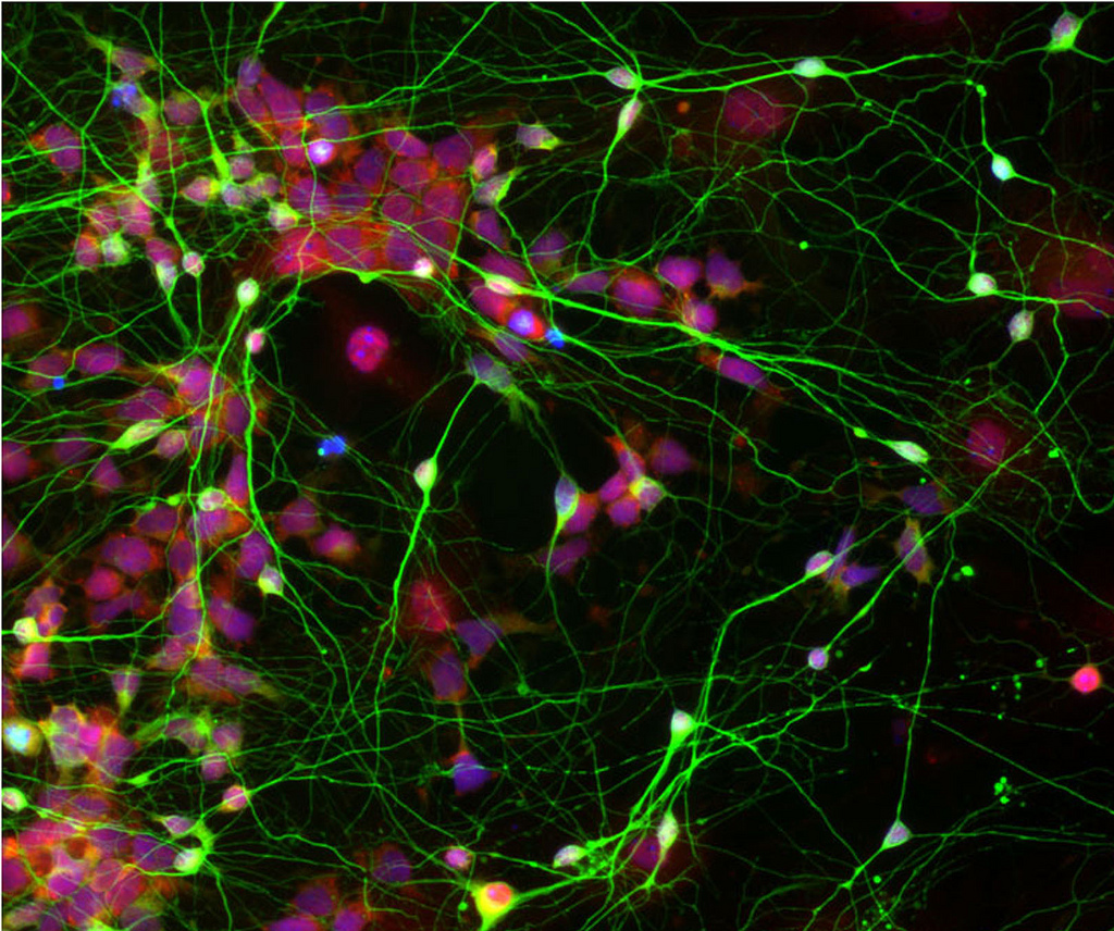 Μετασχηματισμένα κύτταρα «κυνηγούν» όγκους στον εγκέφαλο