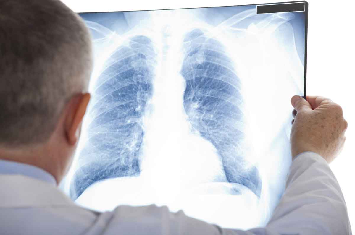 Συστάσεις για ετήσιο έλεγχο για τον καρκίνο του πνεύμονα