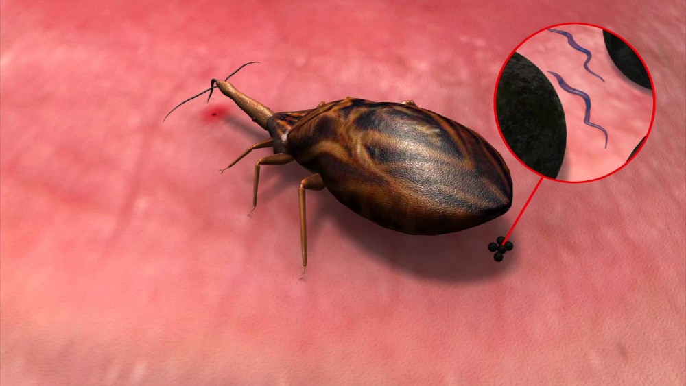 Νόσος του Chagas: 6-7 εκατομμύρια μολύνσεις παγκοσμίως