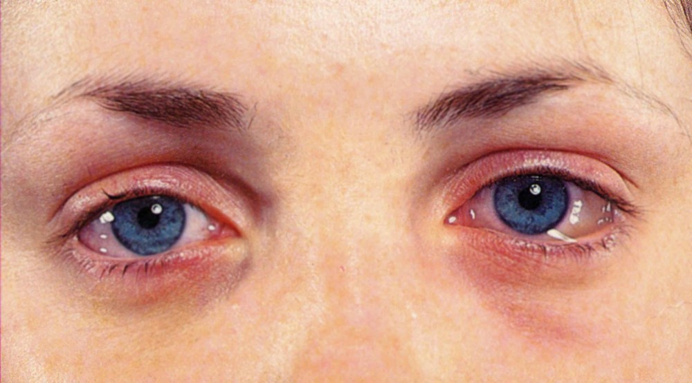 Επιπεφυκίτιδα: οι αλλεργίες στα μάτια