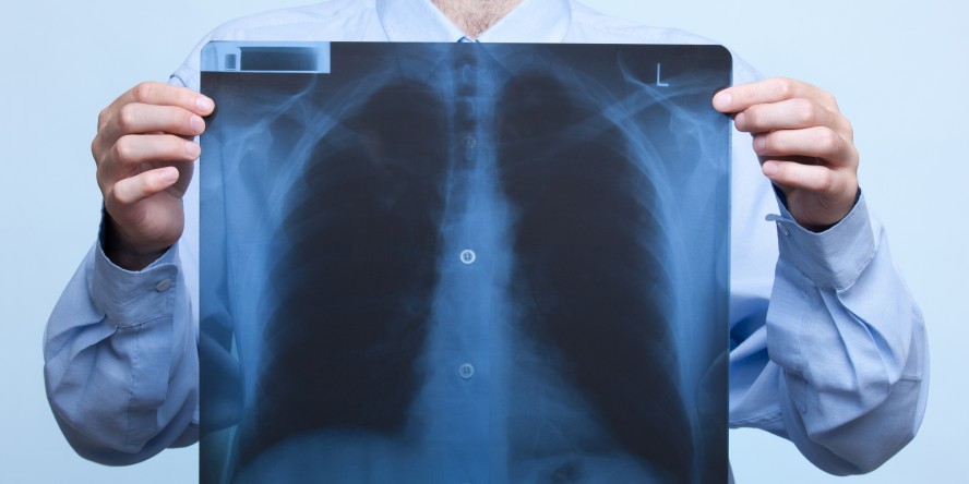 Ο καρκίνος του πνεύμονα κοστίζει τις περισσότερες ζωές