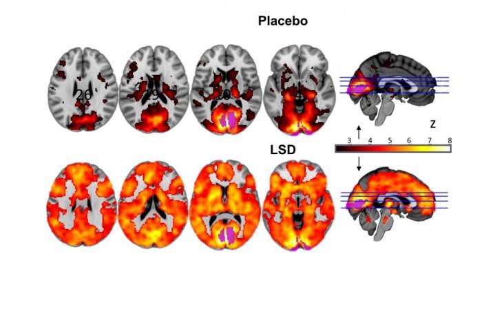Tι προκαλεί στον ανθρώπινο εγκέφαλο το LSD;