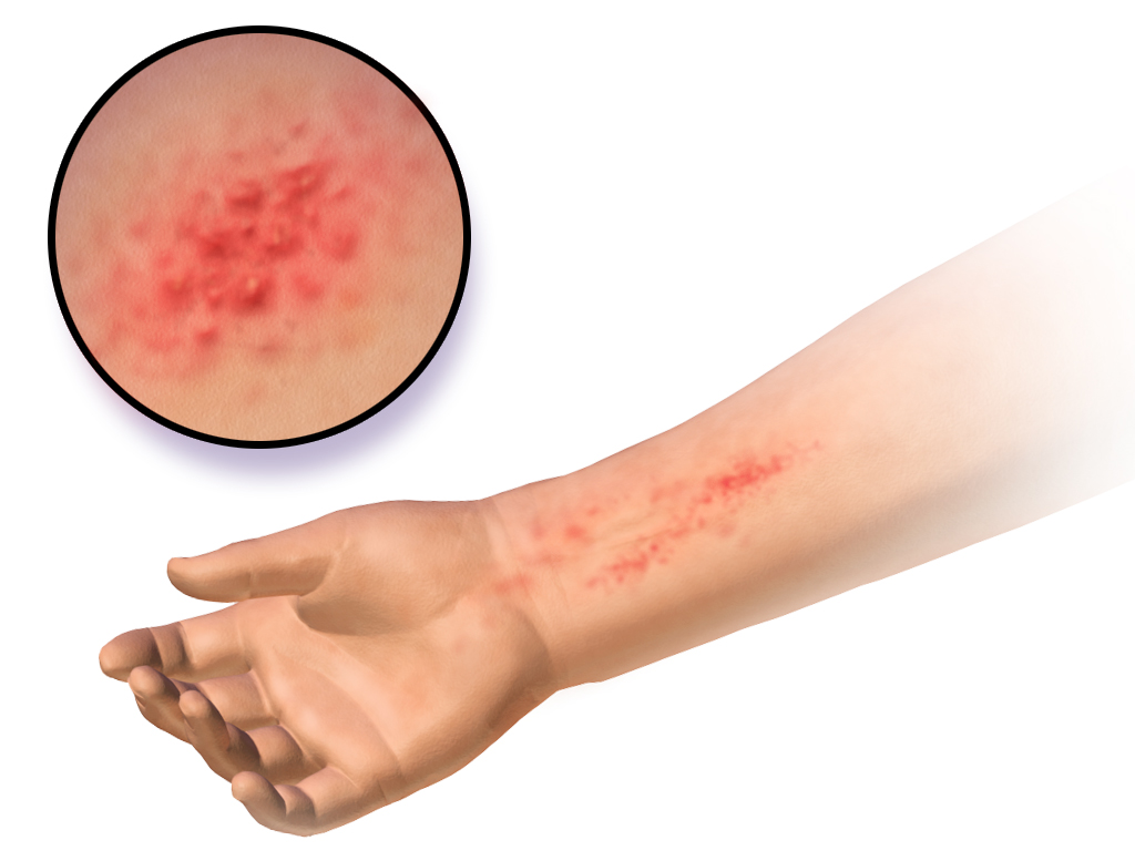 Αλλεργίες που προκαλούν το νικέλιο και το λατέξ