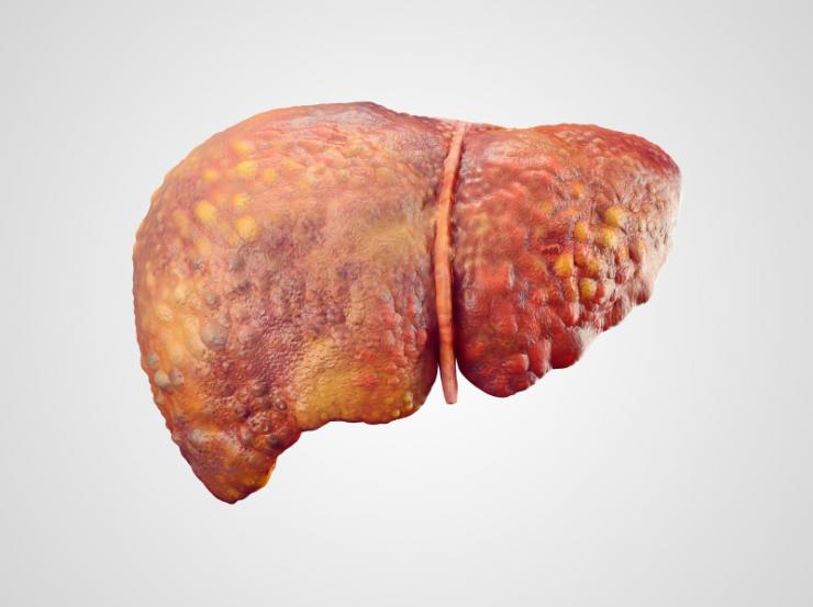 Η σχέση ηπατίτιδας Β με την κίρρωση και τον καρκίνο του ήπατος