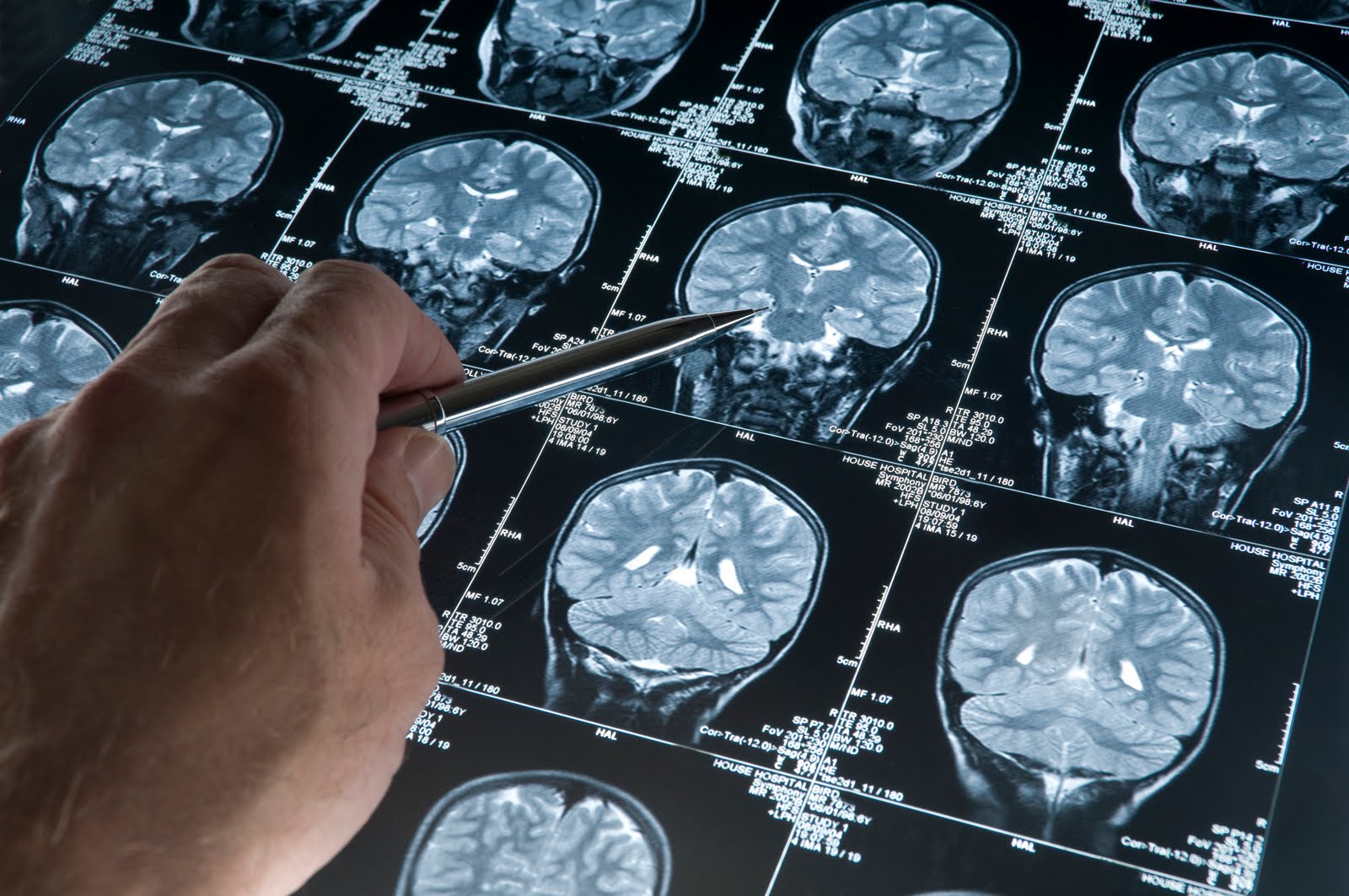 Έγκαιρη διάγνωση του Αλτσχάιμερ με «σάρωση του εγκεφάλου»