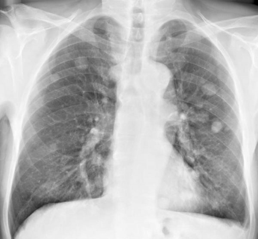 Αναστολή ανάπτυξης όγκων στον πνεύμονα;