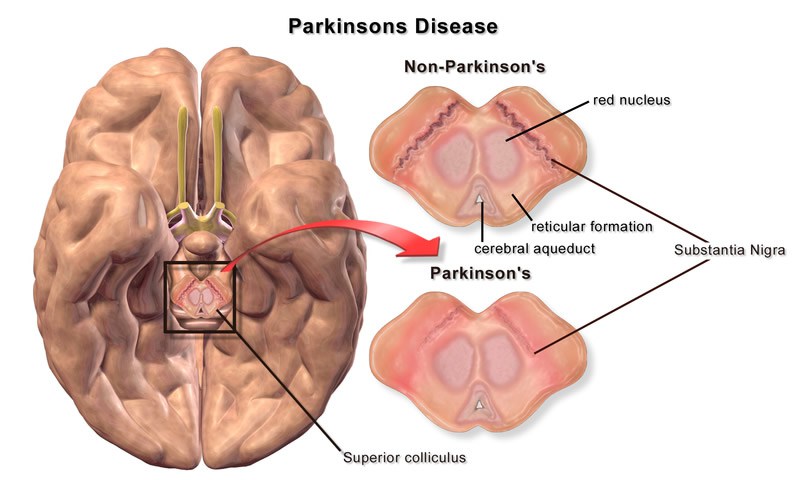 Μια νέα διαταραχή του εγκεφάλου ενοχοποιείται για τη νόσο Πάρκινσον