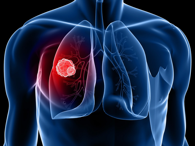 Νέα τυποποίηση του καρκίνου του πνεύμονα βελτιώνει τις θεραπείες