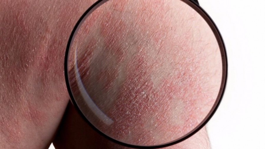 Νέα θεραπεία καθαρίζει σε 4 χρόνια το δέρμα των ασθενών με ψωρίαση