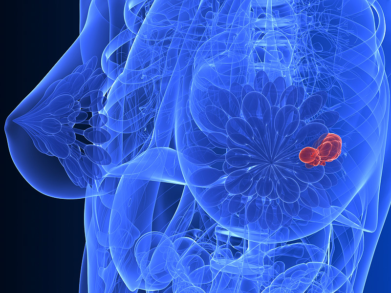 Η βιταμίνη D σχετίζεται με καλύτερη επιβίωση από καρκίνο του μαστού