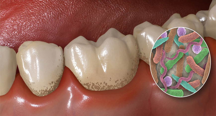 Πως αποφεύγονται οι οδοντικές επιπλοκές του διαβήτη