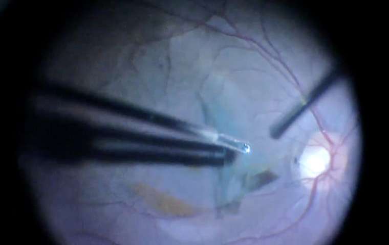 Αποκατάσταση όρασης σε ασθενείς με βλάβες του εγκεφάλου