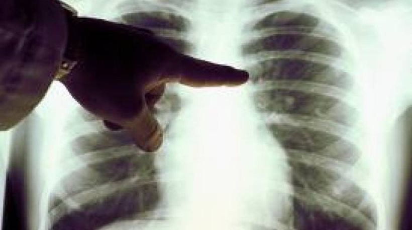 Καρκίνος του πνεύμονα: Τα προειδοποιητικά σημάδια