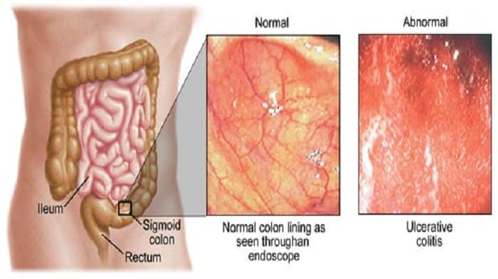 Νέοι βιοδείκτες για τη νόσο Crohn