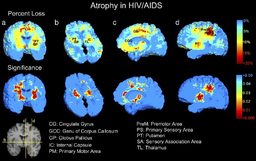 Μαγνητική τομογραφία εντοπίζει τον HIV στον εγκέφαλο