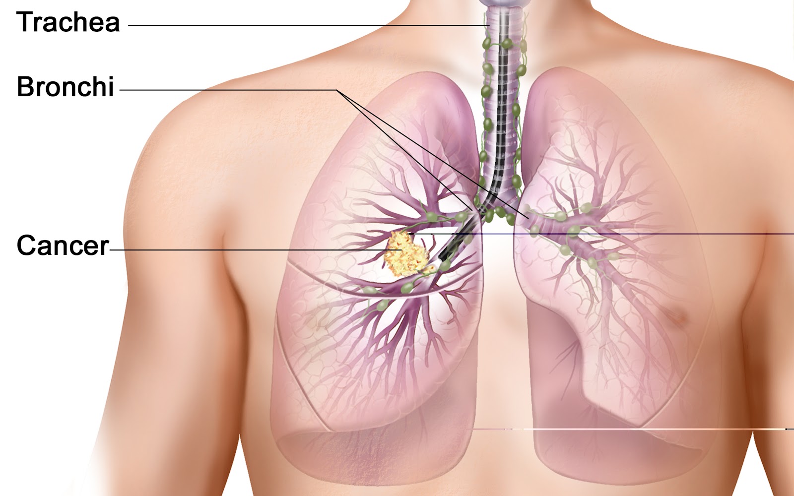 Μέθοδος πρόβλεψης υποτροπής καρκίνου του πνεύμονα