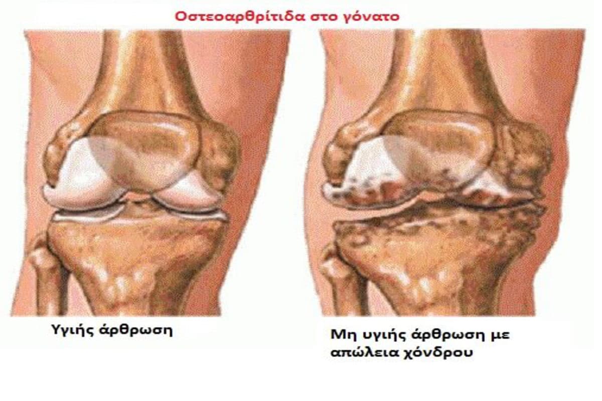 Επαναπρογραμματισμός βλαστικών κυττάρων για αντιμετώπιση της αρθρίτιδας