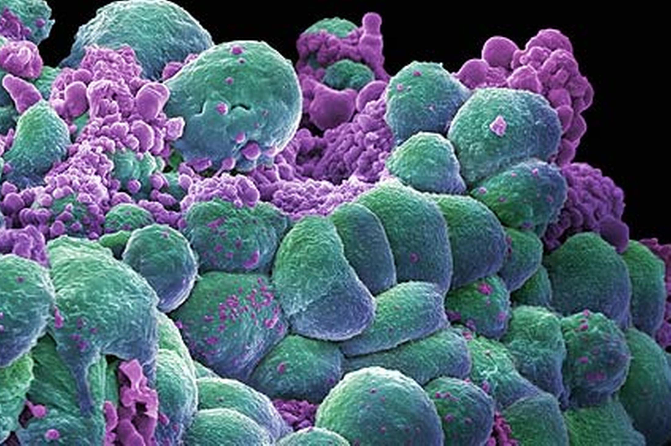 Η πρωτεΐνη scrib αποτελεί φυσικό αναστολέα του ηπατοκυτταρικού καρκίνου