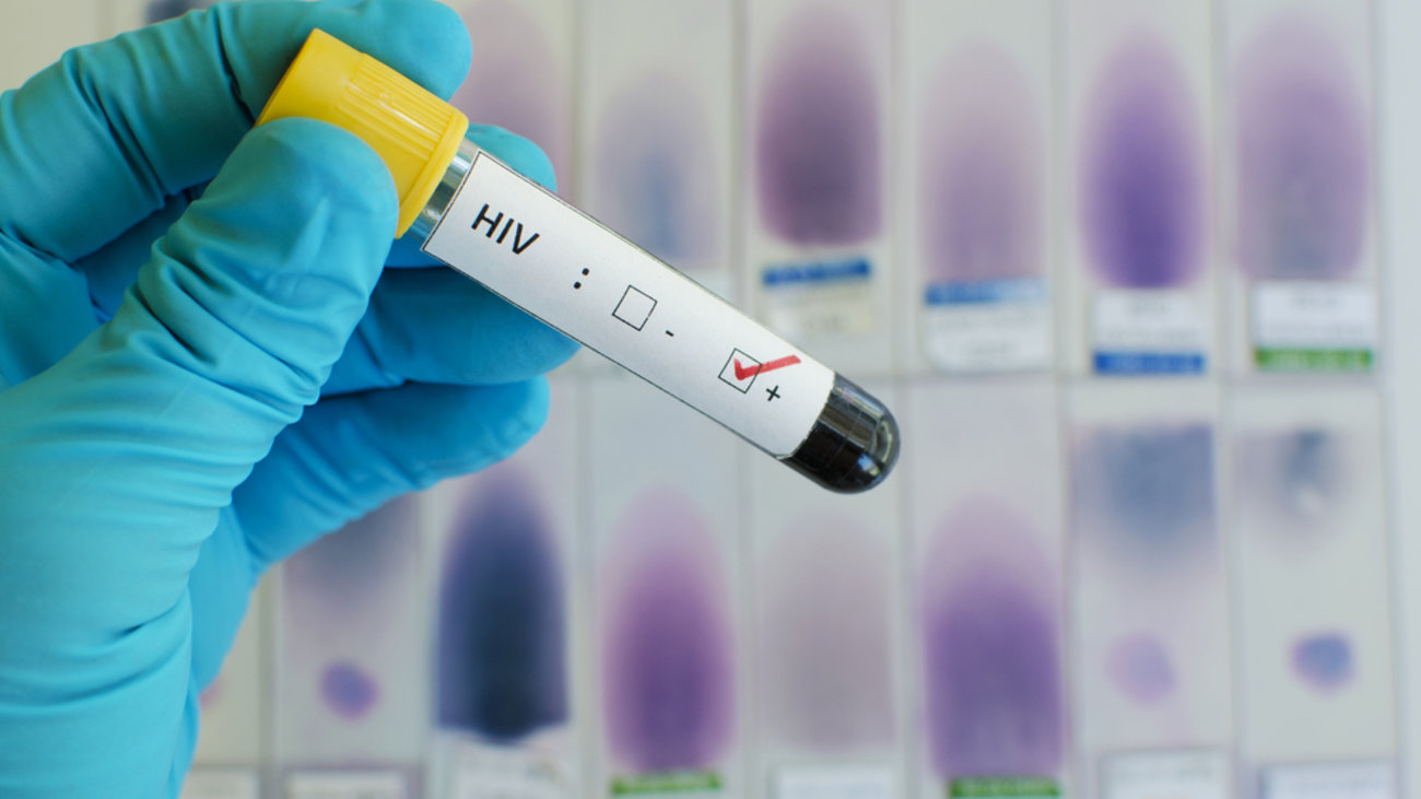 Σημαντικό βήμα προς την παρασκευή εμβολίου για τον ιό ΗIV