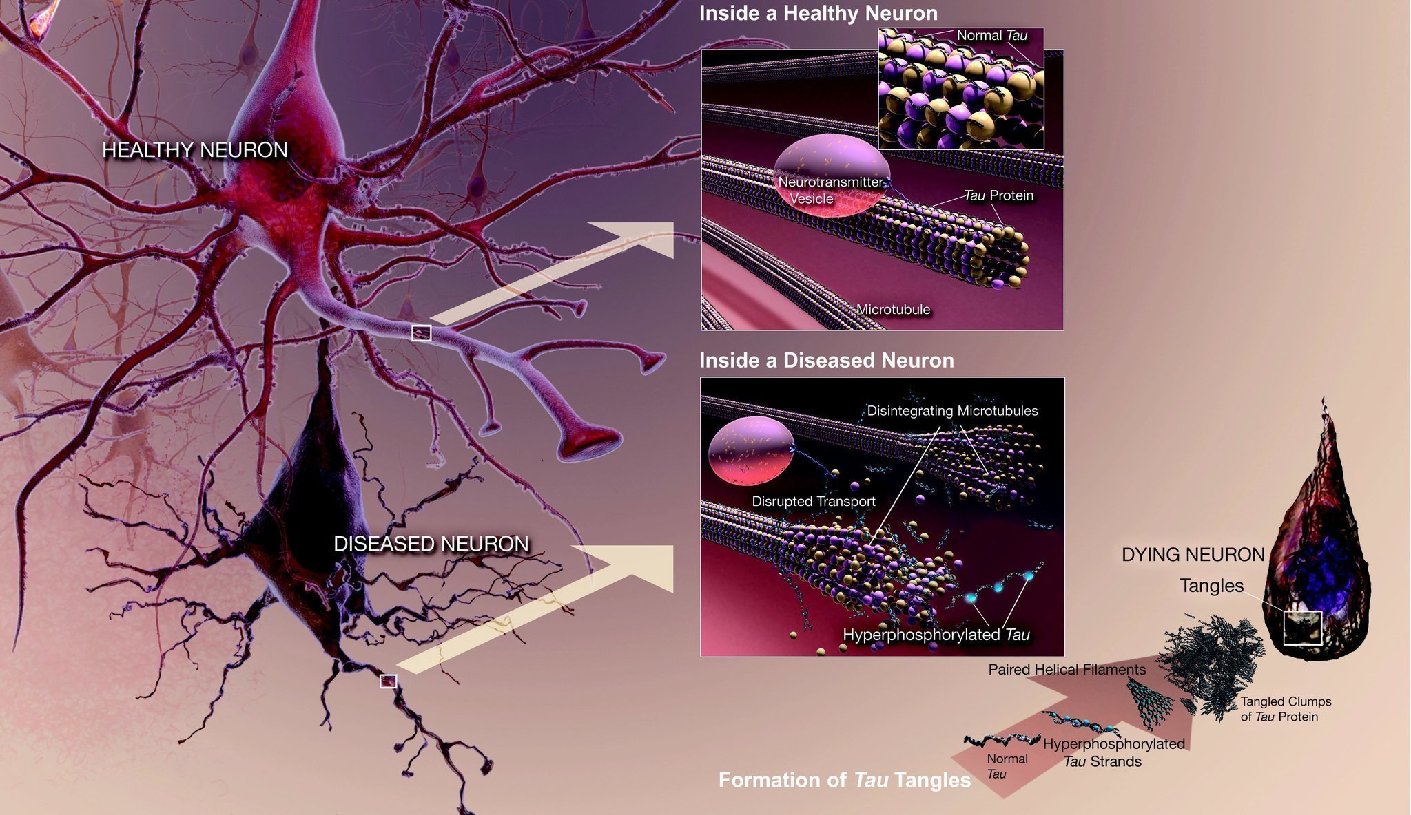 Η πρωτεΐνη tau αποκλείει τη νευροδιαβίβαση στη νευροεκφυλιστική διαδικασία