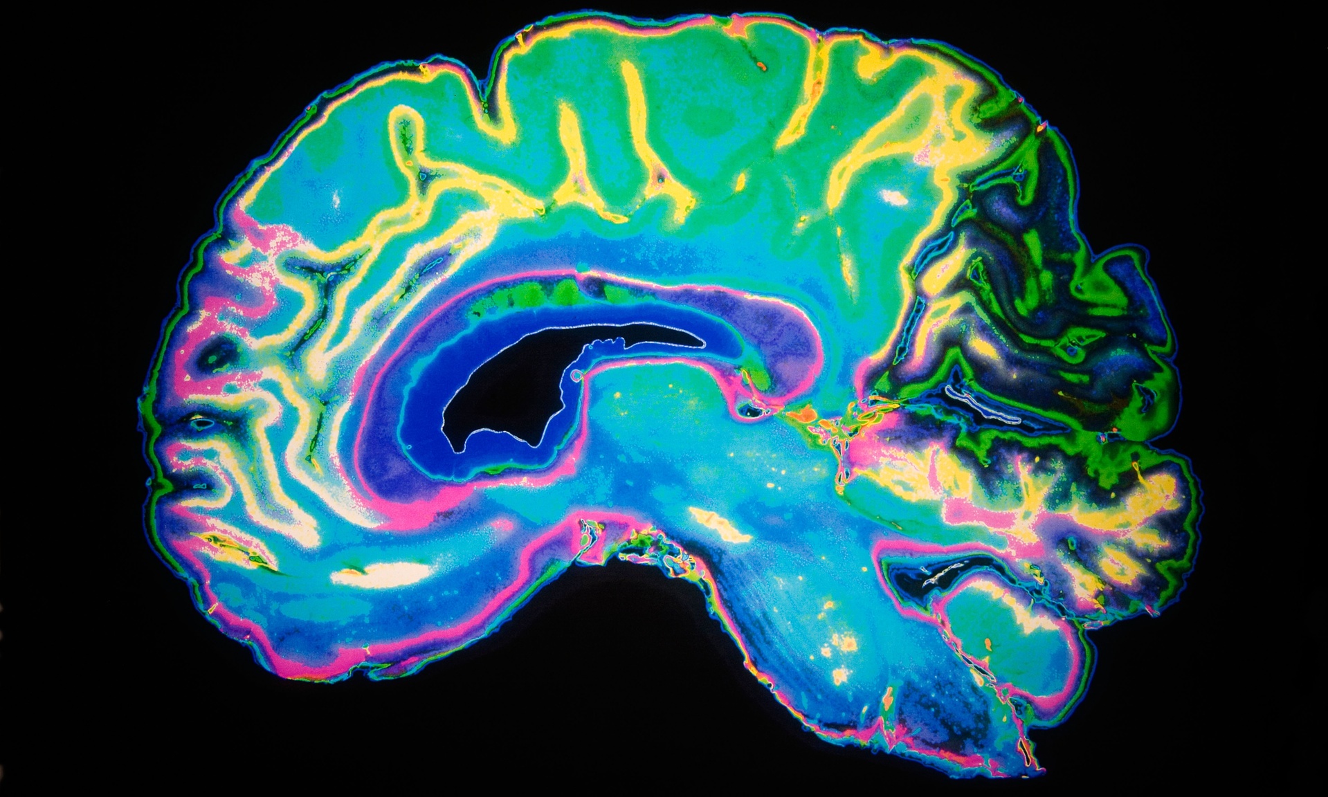 Ο εγκέφαλος διαφέρει σε άτομα με γενετική προδιάθεση για σχιζοφρένεια/αυτισμό
