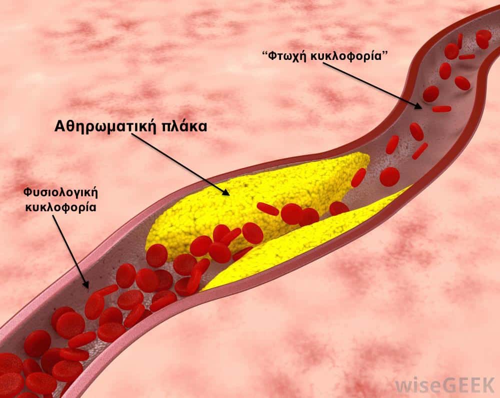 Η εξέταση ΡΕΤ εκτιμά τις αθηρωματικές πλάκες που είναι επικίνδυνο να ραγούν