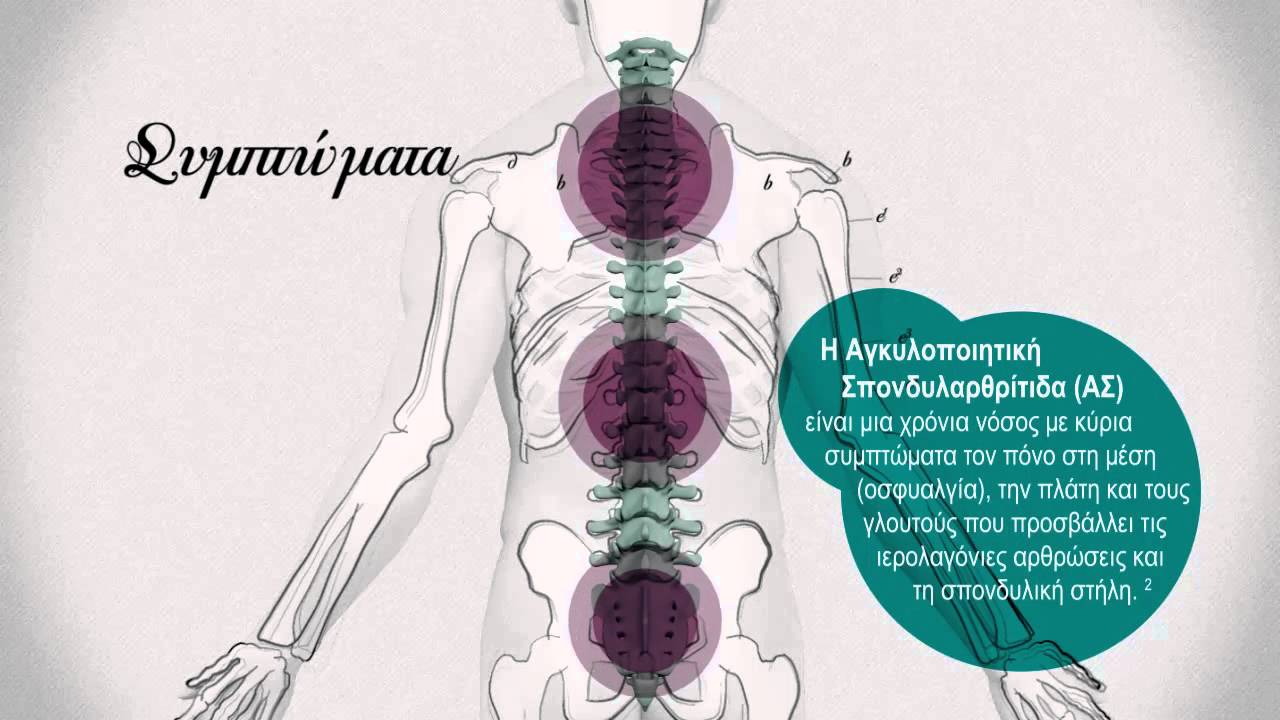 Πως βελτιώνεται  η αξιολόγηση ασθενών με αγκυλοποιητική σπονδυλίτιδα