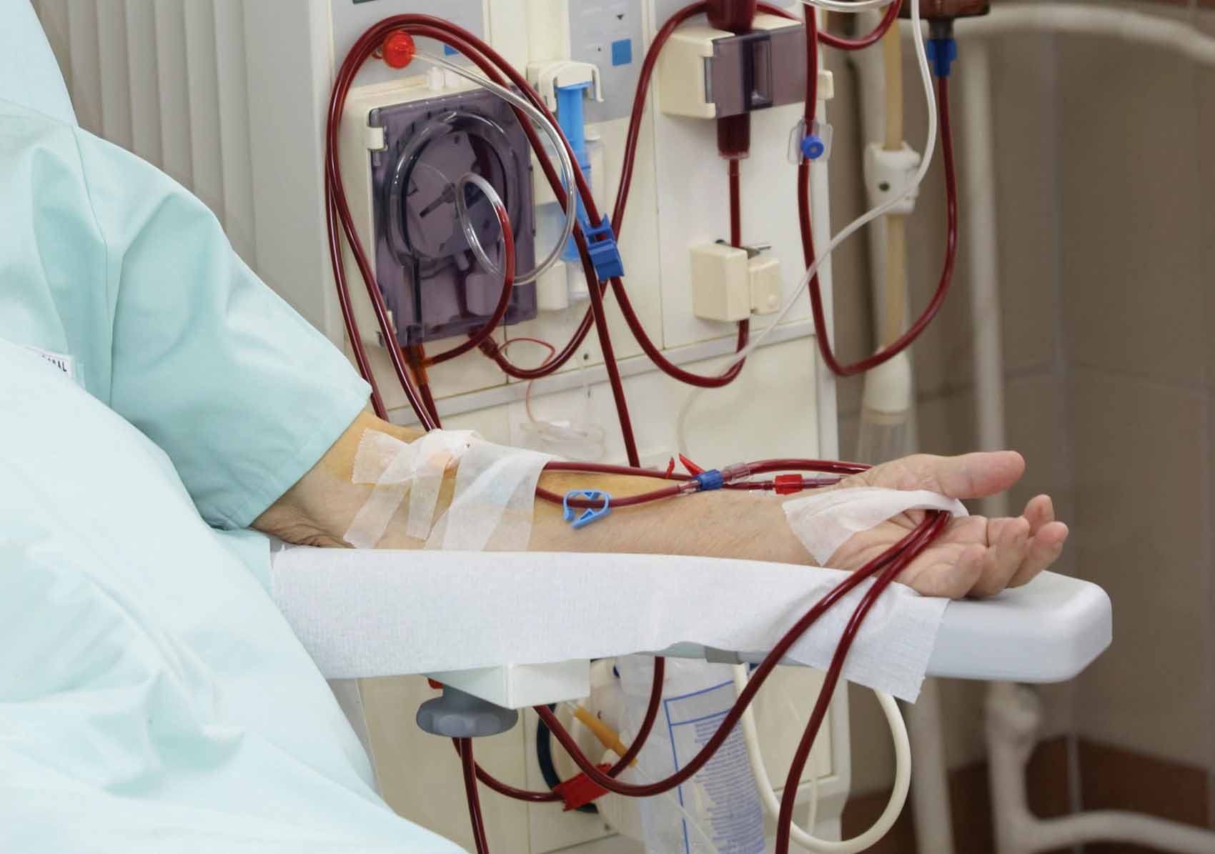 Οι καθετήρες σχετίζονται με λοιμώξεις σε αιμοκαθαιρόμενους