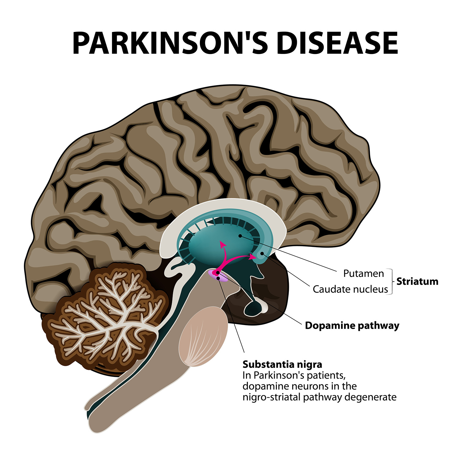 Πρωτεΐνη σχετίζεται με την Πάρκινσον και με λοιμώξεις