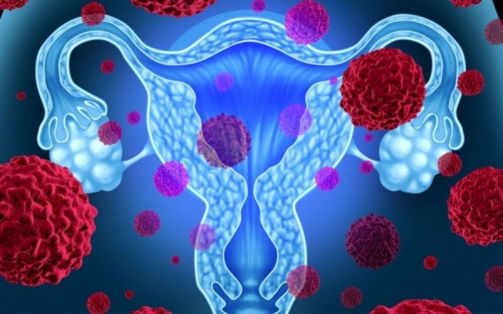 Μαστεκτομή σε φορείς μετάλλαξης BRCA με καρκίνο των ωοθηκών