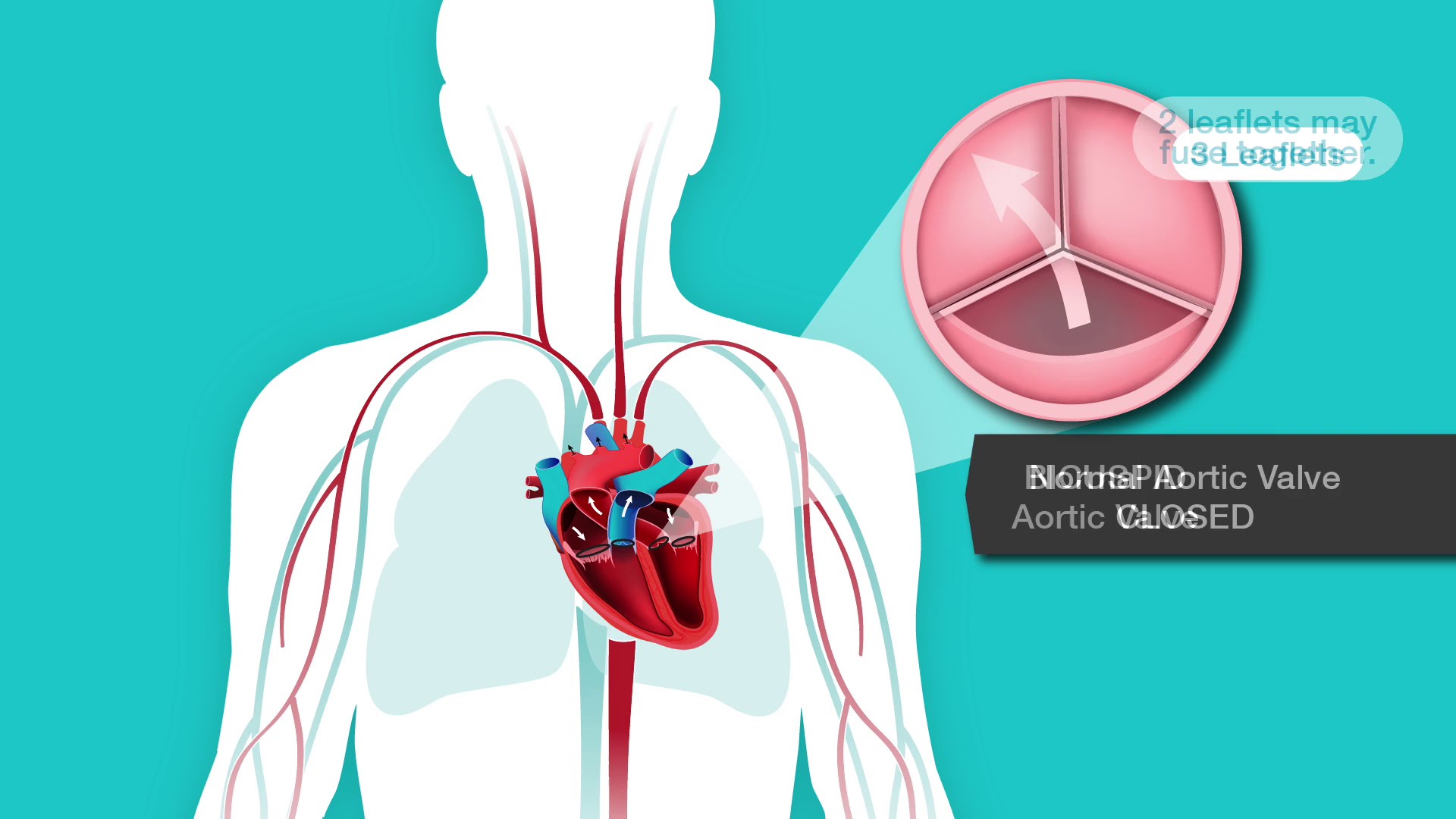 Λιγότερες λοιμώξεις στις μηχανικές βαλβίδες καρδιάς