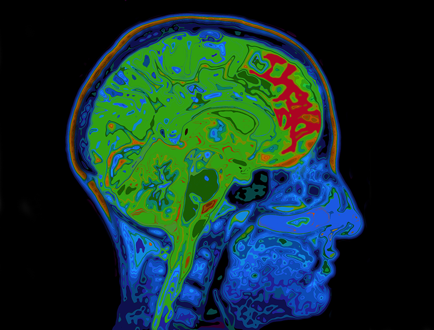 Αυξημένη οξύτητα εγκεφάλου σε ψυχιατρικές διαταραχές